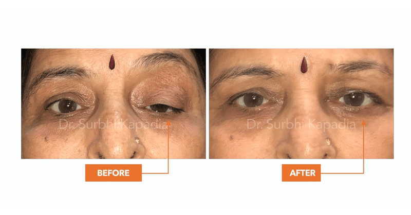 Ptosis Surgery Recovery