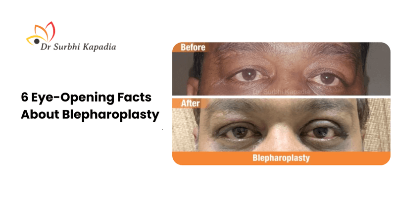 6-eye-opening-facts-about-blepharoplasty