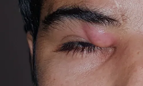 Eye Tumors